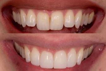 What Are Veneers, and Why Are They Worth It? - Dalton Dental
